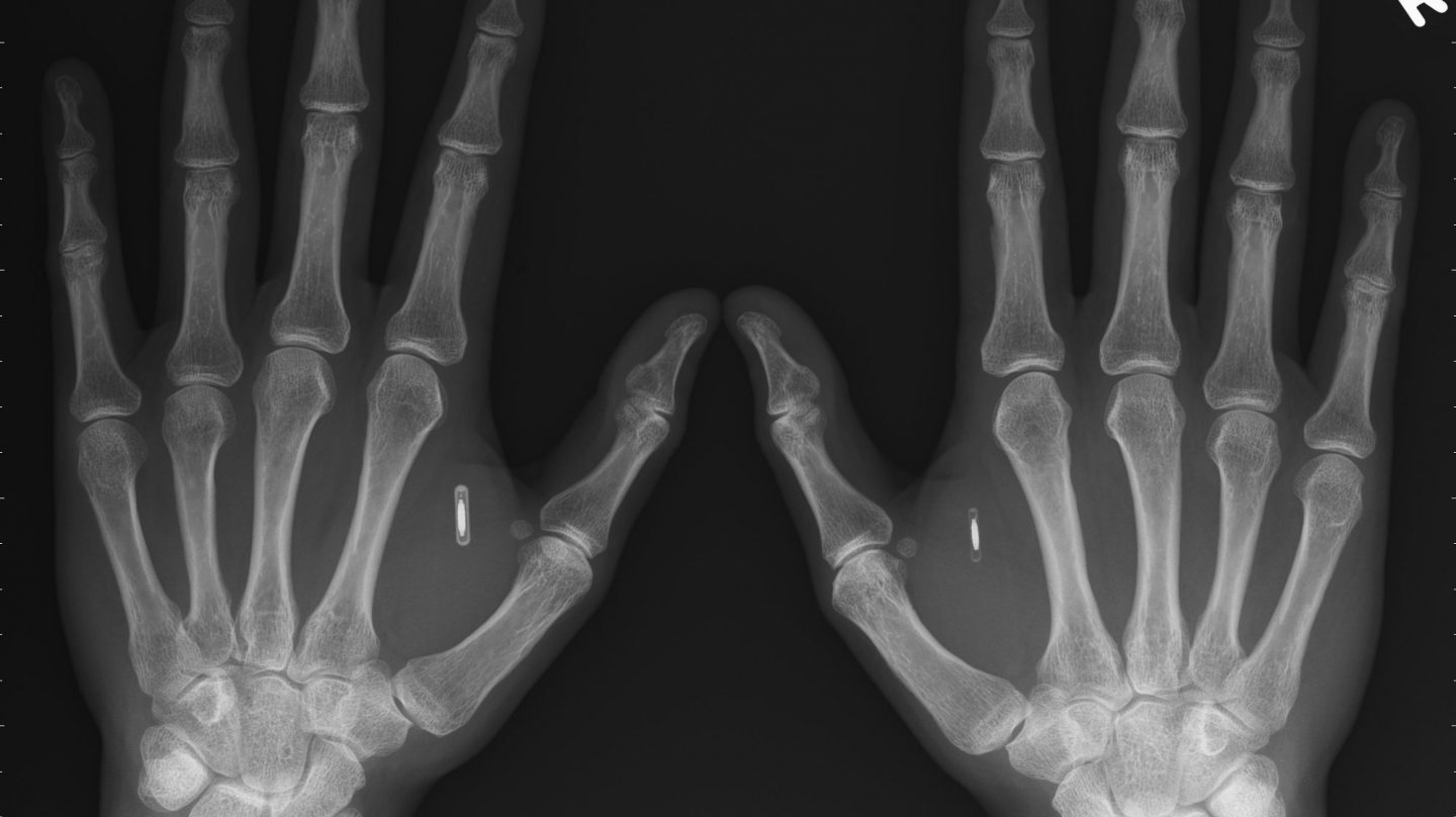 Una radiografía de un paciente con chips implantados en las manos.