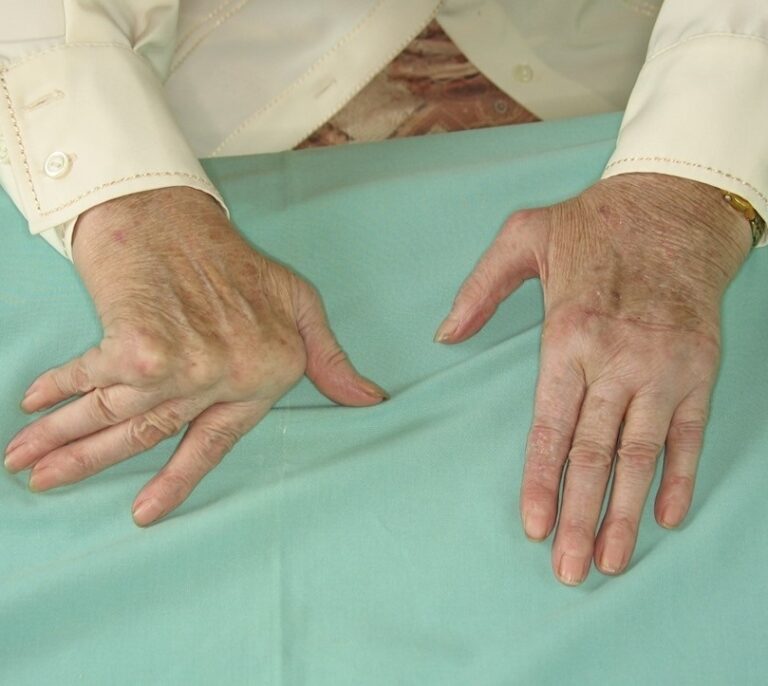 Descubren nuevos mecanismos para combatir la artritis crónica