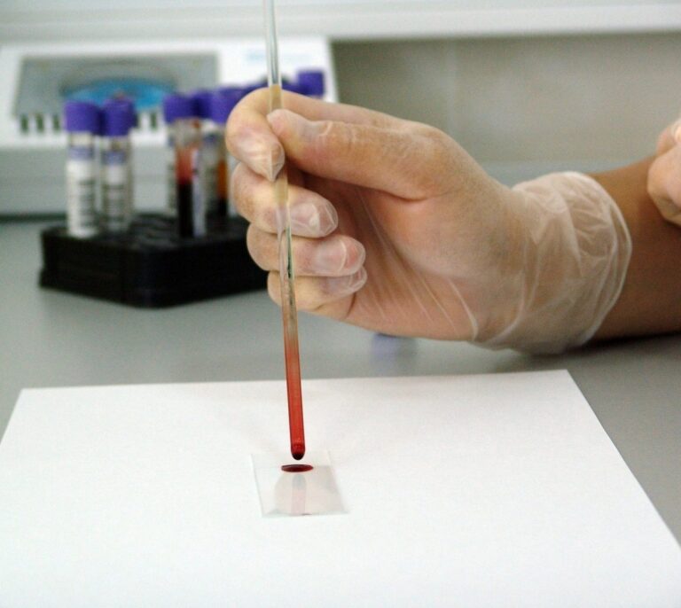 Encuentran un marcador sanguíneo clave en el diagnóstico precoz del cáncer de mama