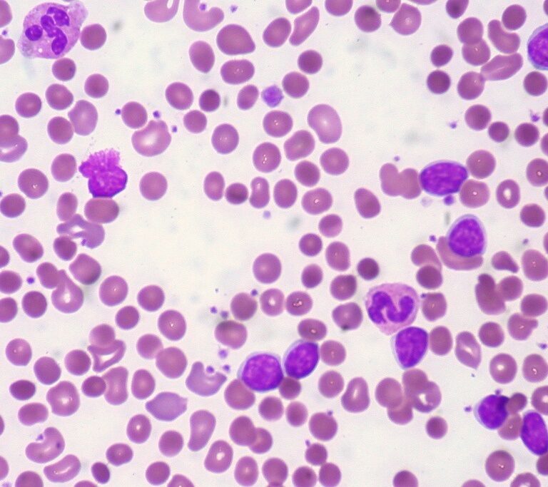 Descifrado el genoma del tipo de leucemia más frecuente