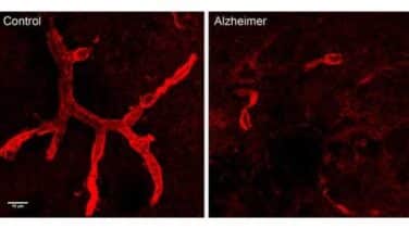 Un anticoagulante logra retrasar la aparición del alzhéimer en ratones