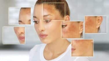 ¿Manchadas por el sol? Cómo prevenir y tratar el melasma