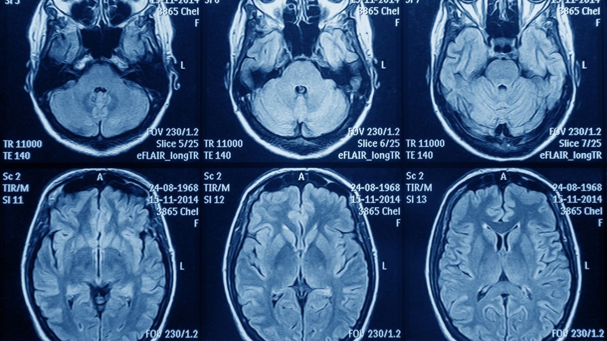 Astuce denuncia que pacientes con glioblastoma "luchan contrarreloj por recibir un tratamiento que prolongaría su supervivencia"