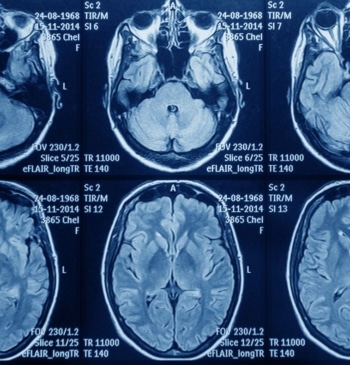 Astuce denuncia que pacientes con glioblastoma "luchan contrarreloj por recibir un tratamiento [...]