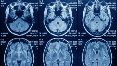 Astuce denuncia que pacientes con glioblastoma "luchan contrarreloj por recibir un tratamiento que prolongaría su supervivencia"